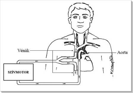 Szvmotor - Extracorporalis kerings vzlata