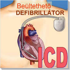 ICD készülék