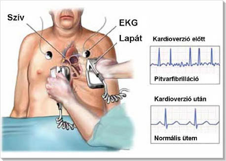 szívritmuszavar tünetek)