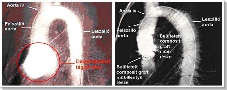 rbetegsgek - DeBakey I disszekci