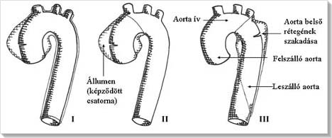 De Bakey aorta disszekció osztályozása rajz