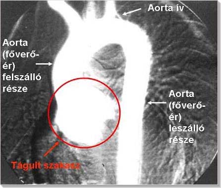 aorta tágulat