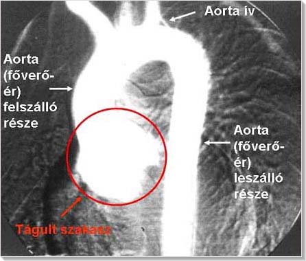 aneurysma szerűen tágult aorta gyök röntgen képen