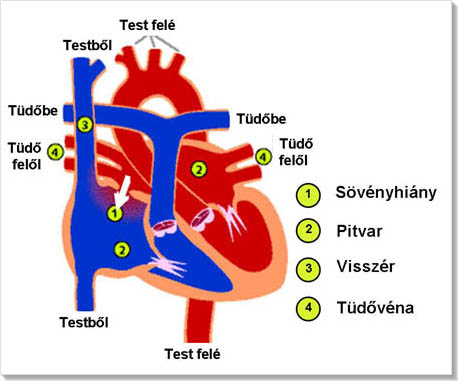 Veleszületett szívhibák tünetei és kezelése - HáziPatika