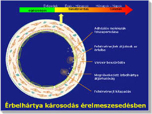 Atheroszklerózis, az érelmeszesedés folyamata