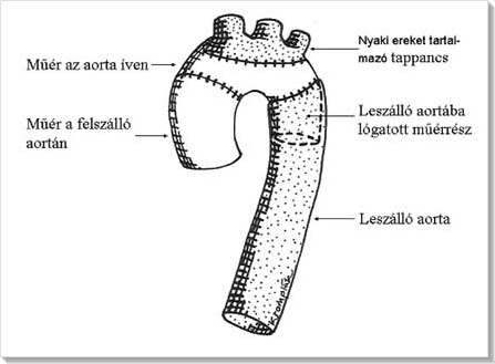 Szívsebészet: Elefant trunk műtét