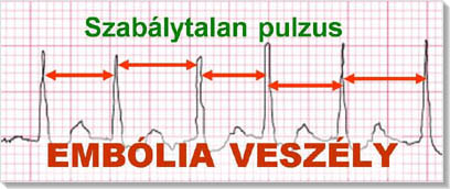 szívritmuszavarok magas vérnyomásban