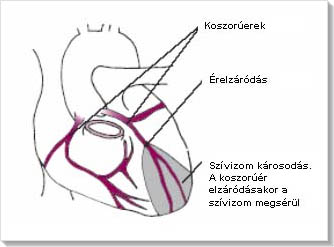 Szívinfarktus 3 oka, 6 tünete, 3 megelőzési módja és 4 fajta kezelése