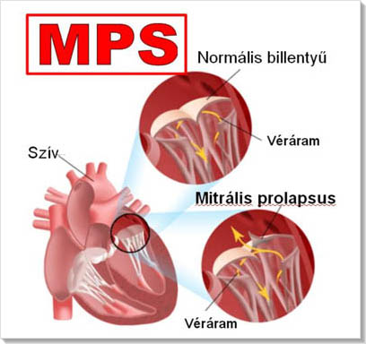 Mitrális prolapsus