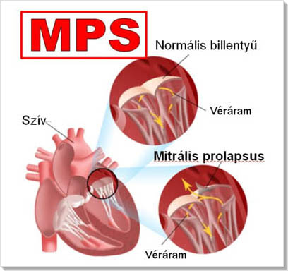 Mitrális prolapsus tünetei és kezelése - HáziPatika